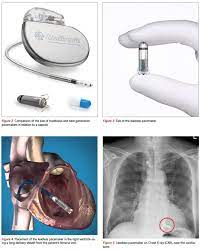 An implantable cardioverter defibrillator (icd) detects tachycardia and fibrillation, and shocks the heart like the pacemaker, an implantable defibrillator device includes a pulse generator and leads. Next Generation Cardiac Implantable Electronic Devices Singhealth