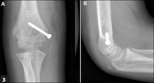Traditional management by cast immobilization increasingly is being replaced with early fixation and mobilization. A 9 Year Old Boy With Elbow Injury