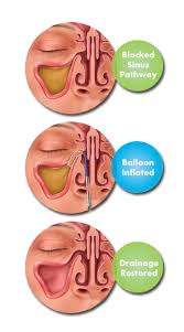 Balloon Sinuplasty Surgery Experts In Nj Essex County Balloons Sinusitis Fluid In Ears