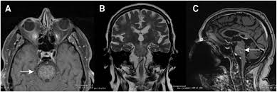 Magnetic resonance imaging (mri) is a medical imaging technique used in radiology to form pictures of the anatomy and the physiological processes of the body. Scielo Brasil Clippers A Recognizable Image Of A Treatable Disease Clippers A Recognizable Image Of A Treatable Disease