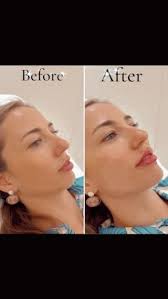 This lovely client had her facial profile balanced with enhancements to her  chin. This was necessary as she wanted more full and plump lips whilst  maintaining her natural lip contour. We also did a ...