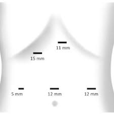 PDF) Laparoscopic Magenstrasse and Mill Gastroplasty. First Results of a  Prospective Study