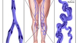 Purtarea ciorapilor de compresie de multe ori prima abordare pe care o puteti incerca inainte de a trece la alte tratamente. Care Este Cel Mai Bun Tratament Pentru Hemoroizi Si Varice Mobile