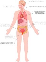 Image result for Autonomic Dysfunction
