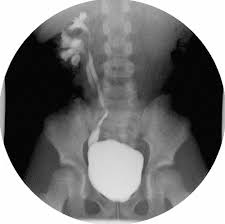 Image result for Voiding Cystourethrogram