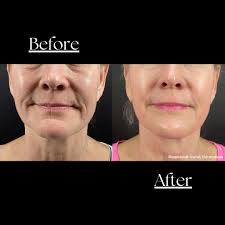 Busy schedule? No problem! ✨ Morpheus8 is your go-to treatment for stunning  skin with minimal downtime. Whether you're looking to tighten, rejuvenate,  or refresh, Morpheus8 delivers real results that fit into your