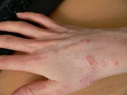 Coming up, we're going to show you cleaners that kill these 3 ringworm causing skin plants once and for all on hard surfaces. Athlete S Foot On Your Hand Symptoms Causes And Treatments Destroy Nail Fungus