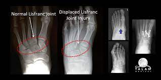 It can occur in one or both feet. Cam Newton Has Football Fans Asking What A Lisfranc Sprain Is And The Prognosis Looks Like Talar Medical