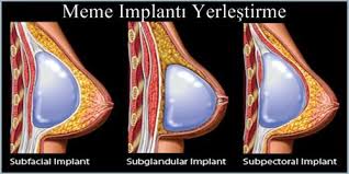 Gogus Estetigi Ve Meme Implantlari Hakkinda Bilinmesi Gerekenler Meme Implant Gogus Saglik Estetik