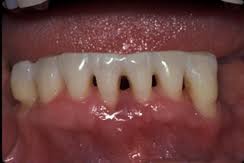 If you are thinking of using super glue to fix, don't attempt so. Stabilization Of Loose Teeth Cherry Hill Nj How To Treat Loose Teeth