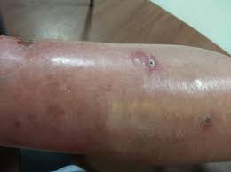 Another Case Of Flesh Eating Bacteria In Sarasota Patient Says News The Destin Log Destin Fl