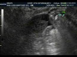 Primeiras Imagens Do Meu Baby Us 5 Semanas E 4 Dias Youtube