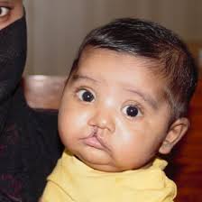 Image result for Cleft Lip