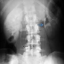 Image result for Intravenous Pyelogram