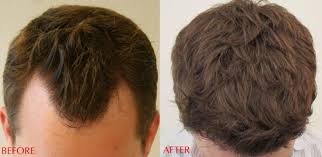 At Alvi Armani We Believe That Hair Transplantation Is More Art Than Science And Nobody Does It Better Than Dr Baubac Hair Restoration Hair Long Hair Styles