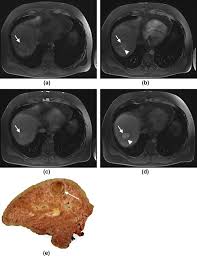 Comparison of LI-RADS with other non-invasive liver MRI criteria and  radiological opinion for diagnosing hepatocellular carcinoma in cirrhotic  livers using gadoxetic acid with histopathological explant correlation -  Clinical Radiology