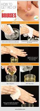 Home Remedies To Get Rid Of Bruises Fast On Legs Arms And Face Bruises Remedy Bruises Home Remedies