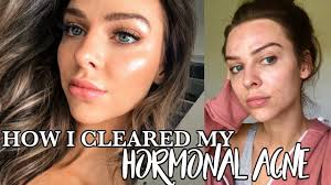 Read my story to see what worked and what changed my life. How I Cleared My Skin Fast Adult Hormonal Acne Youtube