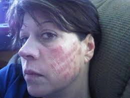 Laser hair removal is an extremely safe and effective procedure in removing hair and preventing future growth. Burns On Face After Laser Hair Removal Laser Hair Removal Forum