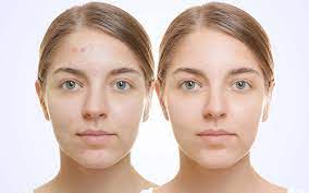 Glycolic acid can be found in all sorts of products, from washes to toners to medical grade chemical peels, says dr what are the best glycolic acid products? Glycolic Acid Vs Salicylic Acid For Skin Exfoliation