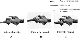 The examiner draws an imaginary line from the anterior superior iliac spine to the ischial tuberosity on the same side of the hip/pelvis. Https Onlinelibrary Wiley Com Doi Pdf 10 1002 Ca 20050