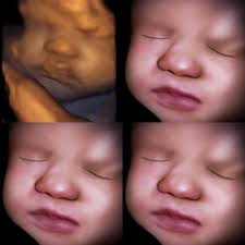 Ultrasound Louisiana — Blog — First Glimpse Prenatal Imaging