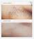 Brazilian Hair Removal Before And After