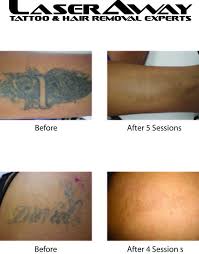 To use this method, mix 100 gms of salt with lemon juice and soak a cotton ball in that solution. Laser Tattoo Removal Before After Laseraway Laser Tattoo Laser Tattoo Removal Laseraway