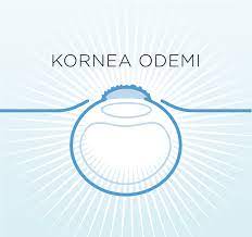 Kornea Odemi Dr Baris Sonmez Goz Hastaliklari Uzmani