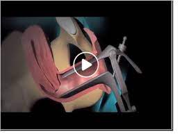 المنظار الرحمي و دوره فى التشخيص والعلاج مستشفى الامم مصر videos okay gesture