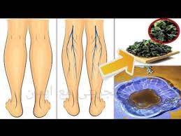 جعله الله علاج دوالي الساقين يشفي بسرعة جميع انواع الدوالي ادهش الاطباء Youtube Beauty Skin Care Routine Varicose Vein Remedy Beauty Skin Care