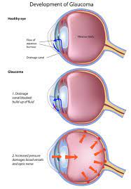 How Quickly Does Glaucoma Progress? | Saland Vision | Dallas