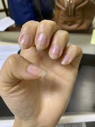 A bite is a wound received from the mouth of an animal or human. 13 Products To Help Stop Nail Biting