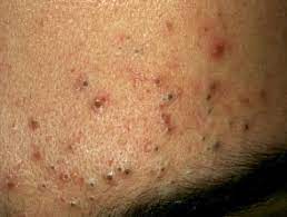 Acnes 52% of the cases. Comedonal Acne Dermnet Nz