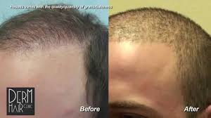 I would like to invite you to take the time to explore our website to learn about our fine products, and how you can benefit from our affordable hair replacement services. Los Angeles Fue Hair Transplant Buzz Cut After Body Hair Transplant And Strip Scar Repair Youtube