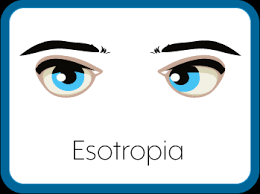 See full list on aoa.org Esotropia