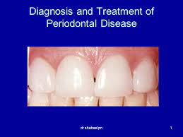 Diagnosis And Treatment Of Periodontal Disease Ppt Video Online Download