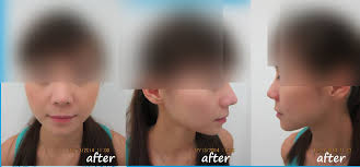Mbbs (madras), ms (plastic surgery, usm), am (mal) fellowship in burns, laser & aesthetic surgery (taiwan) consultant plastic. Aesthetic Clinic Laco Rhinoplasty Laco