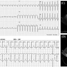 This was svt's first logo. Pdf Supraventricular Tachycardia As The Initial Presentation Of Bacterial Infective Endocarditis A Rare Case Report