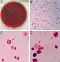 Urinary tract infection caused by S. mitis/oralis | IDR