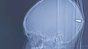 Usually boys start their growth spurt about 2 years after puberty starts. Surgeons Safely Remove Mystery Bullet From Boy S Brain Israel21c