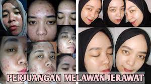 Menghilangkan Jerawat Youtube