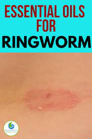 Top 7 Essential Oils For Ringworm Essential Oils For Ringworm Treating Ringworm Ringworm