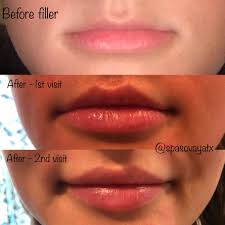 X39 stem cell activating patches are one of my new top 5 favorite biohacks. A Wonderful Example Of Multiple Visits Multiple Syringes And Patience Resulting In A Perfect Total Lip Transformation Medica Lip Fillers Lips Botox Fillers