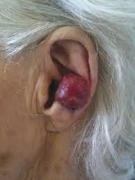 Merkel cell carcinoma (mcc) is a rare but highly aggressive neuroendocrine carcinoma of the skin, with frequent recurrences, metastasis, and a high mortality rate. Merkel Cell Carcinoma The College Of Family Physicians Of Canada