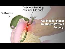 Home remedy of gallbladder stone i ُwithout surgery gallbladder stones removal urdu / english. Gallbladder Stones Removal Without Surgery How To Pass Dissolve Gallstones Fast Naturally Youtube Gallbladder Gallbladder Stones Gallstones
