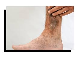 Image result for Stasis Dermatitis