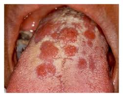 Syphilis is a very dangerous sexually transmitted infection, caused by a syphilis: Oral Secondary Syphilis Papular Lesions On The Dorsum Of The Tongue Download Scientific Diagram