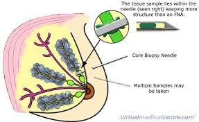 (1) a surgical procedure in which a small piece of tissue is removed from a patient. Core Biopsy Myvmc