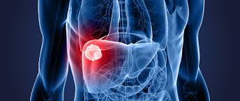 The likelihood of surviving a diagnosis of childhood cancer depends on the country in which the child lives: Liver Cancer World Cancer Research Fund International